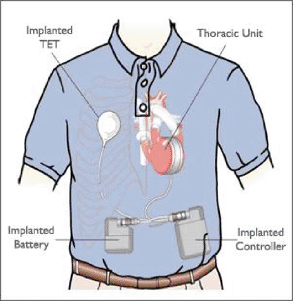 Imagen: El sistema AbioCor (Foto cortesía de Abiomed). Imagen: El sistema AbioCor (Foto cortesía de Abiomed).